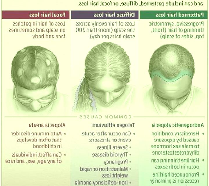 Propecia diffuse patterned alopecia propecia pharmacy