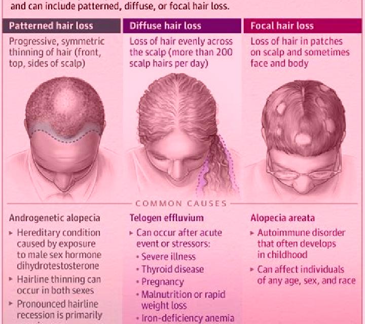 Propecia diffuse patterned alopecia propecia pills