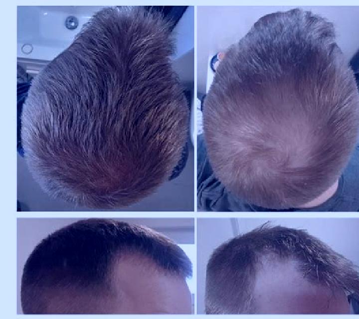 Propecia diffuse thinning propecia medication