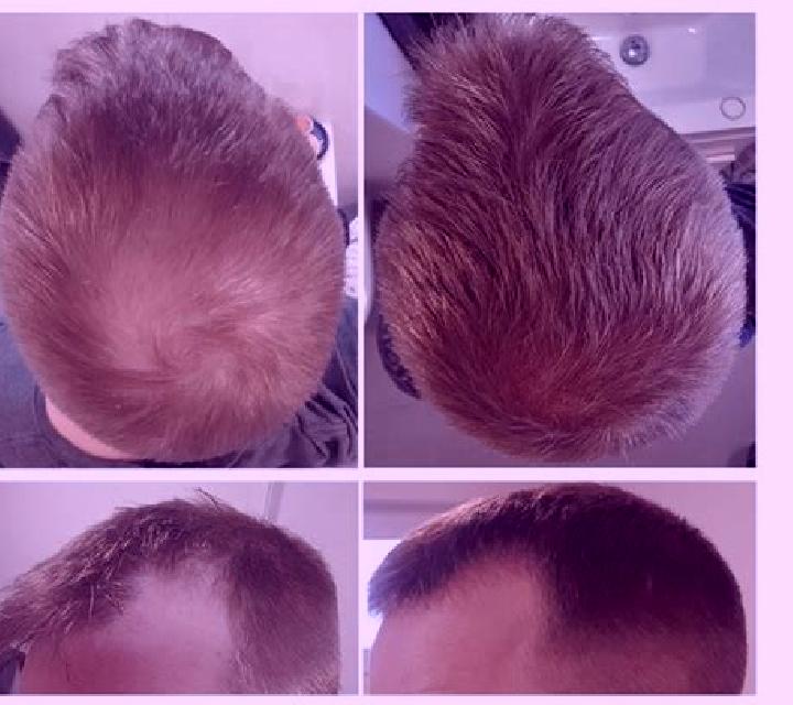 Propecia diffuse thinning propecia results site www.baldtruthtalk.com tablet