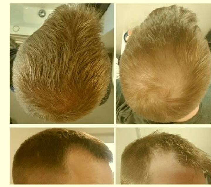 Propecia diffuse unpatterned alopecia propecia tablet