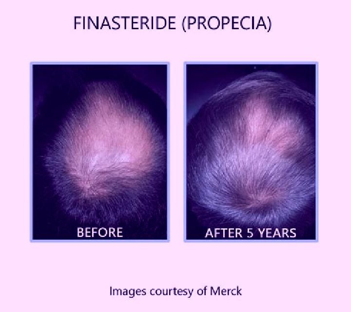 Propecia does increasing propecia help if not responding pills