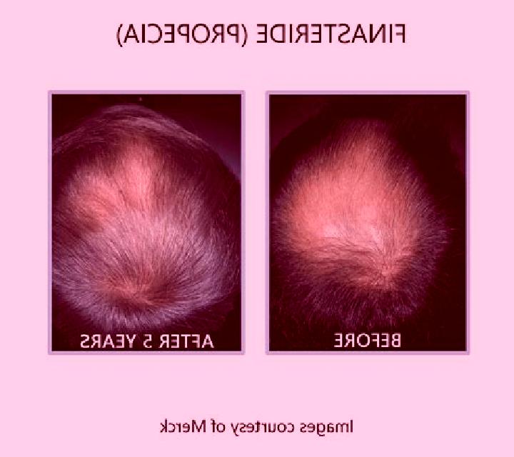 Propecia does losing weight effect propecia pharmacy