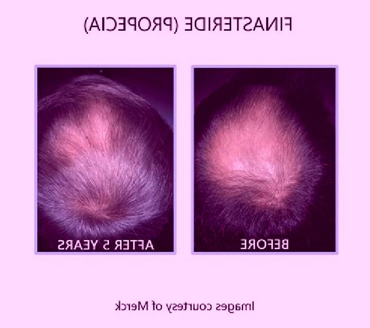 Propecia does losing weight effect propecia tablet