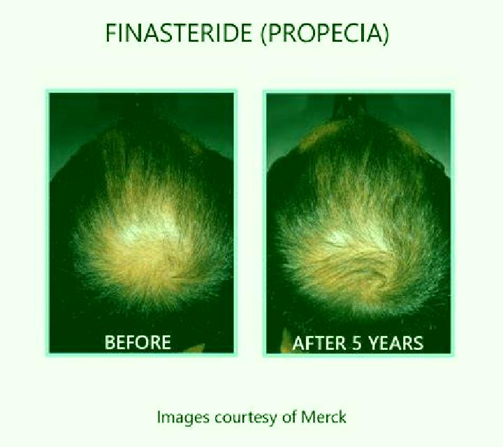 Propecia does propecia or finasteride work medication