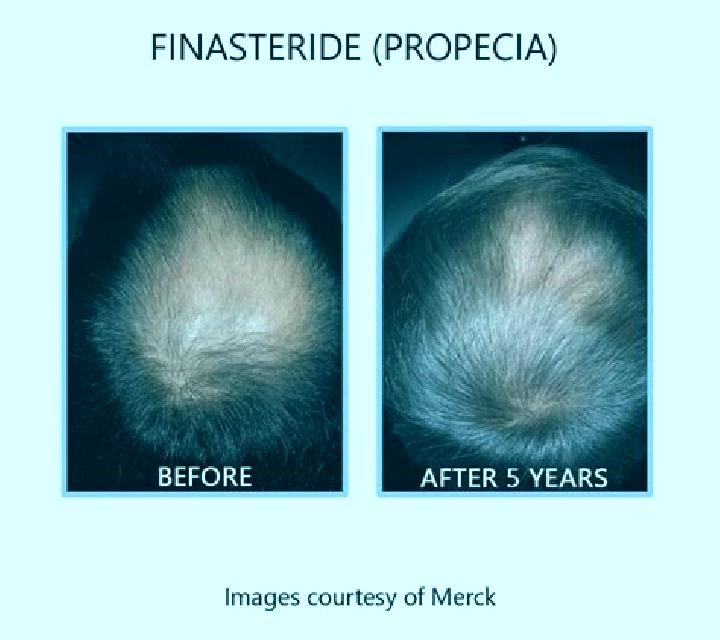 Propecia does propecia or finasteride work pharmacy