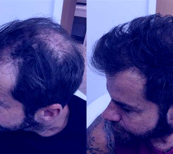 Propecia does propecia stop balding pharmacy