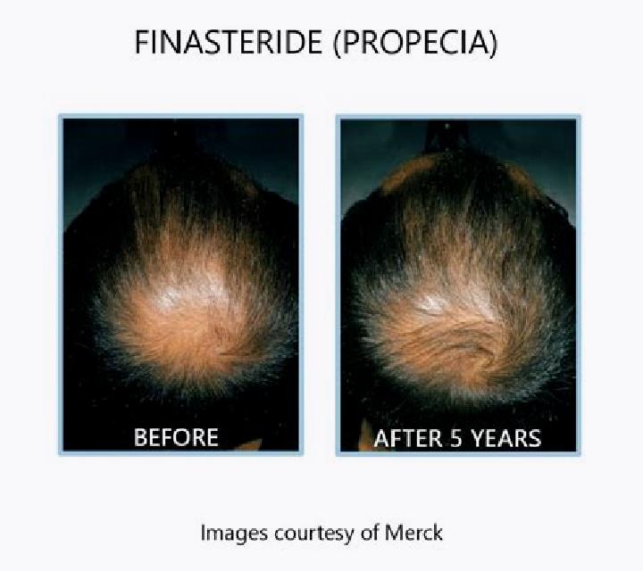 Propecia does propecia work better than finasteride medication