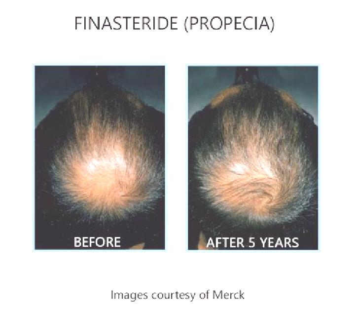 Propecia does propecia work better than finasteride pharmacy
