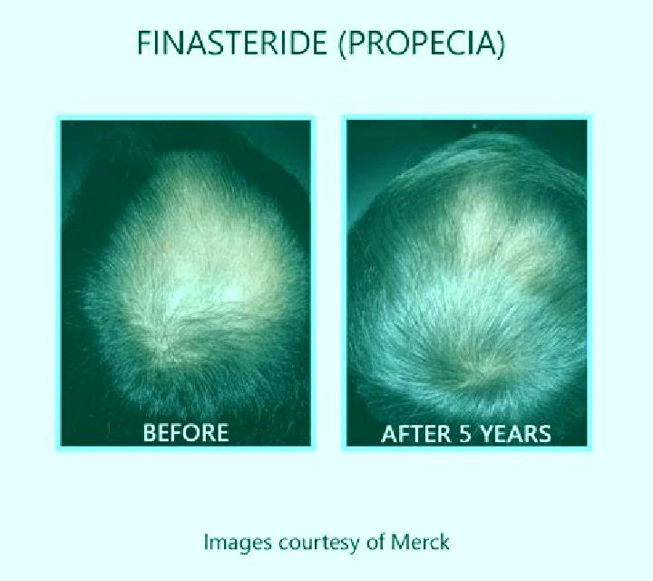 Propecia does propecia work for diffuse pattern alopecia pharmacy