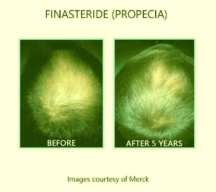 Propecia does propecia work for diffuse pattern alopecia pills
