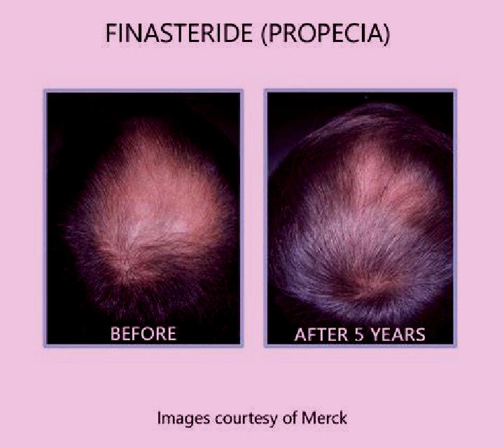 Propecia does propecia work for diffuse pattern alopecia tablet