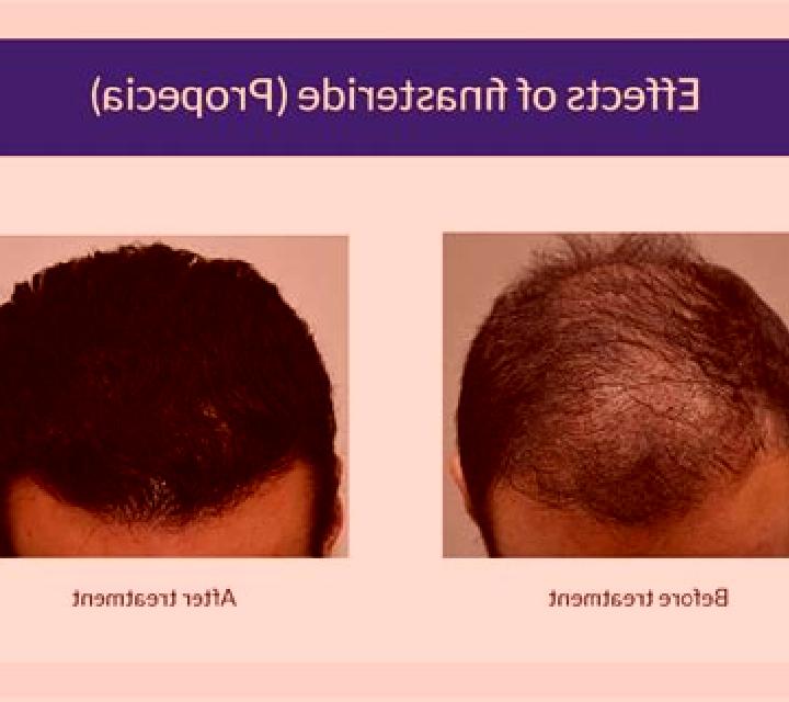Propecia does propecia work for diffuse thinning medication