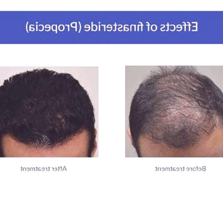 Propecia does propecia work for diffuse thinning tablet