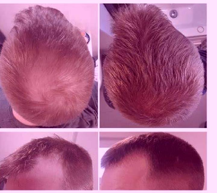 Propecia propecia and diffusing thinning pills