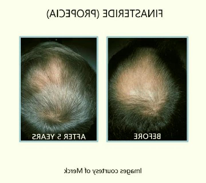 Propecia propecia before after medication
