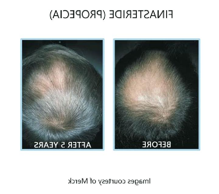 Propecia propecia before after tablet