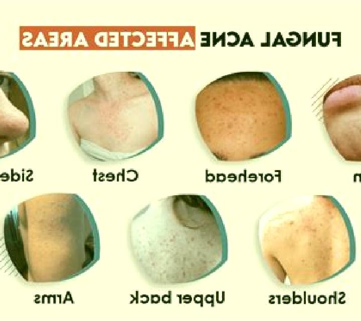 Propecia propecia causing acne tablet