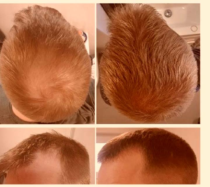 Propecia propecia causing diffuse thinning medication