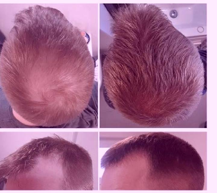 Propecia propecia causing diffuse thinning pharmacy
