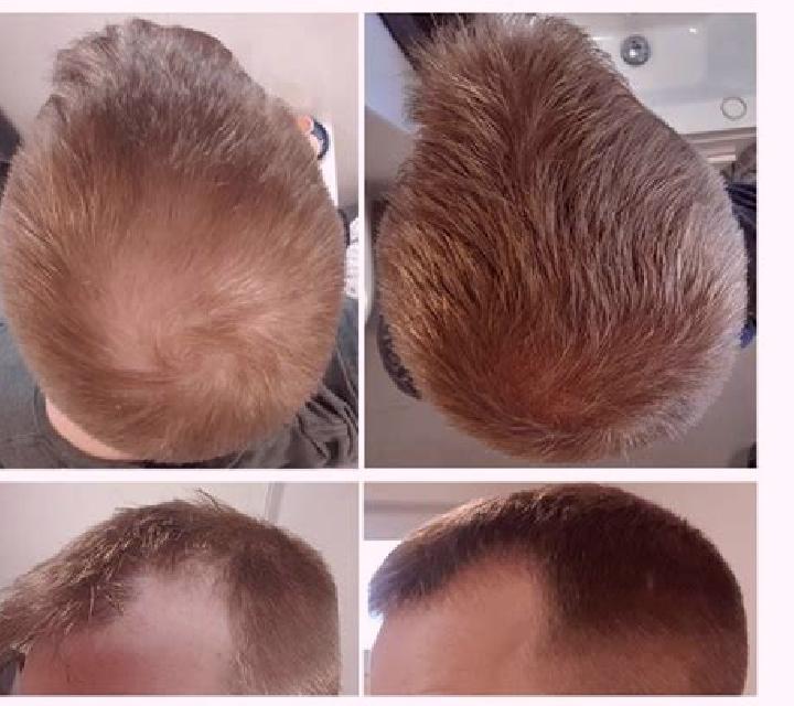 Propecia propecia causing diffuse thinning tablet