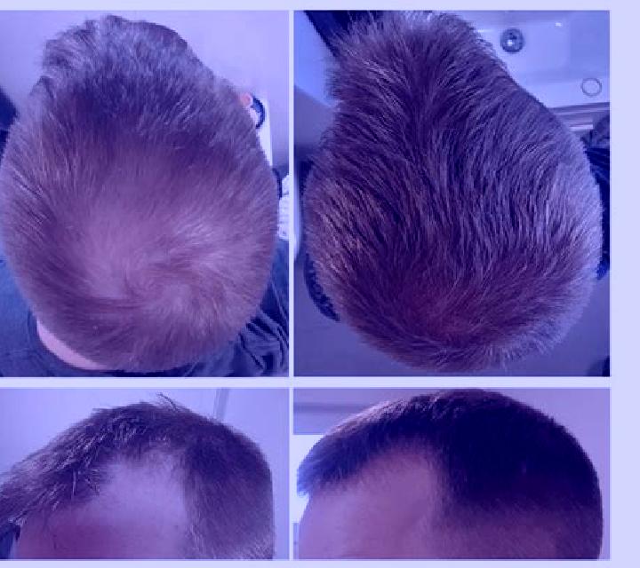 Propecia propecia diffuse thinning pharmacy