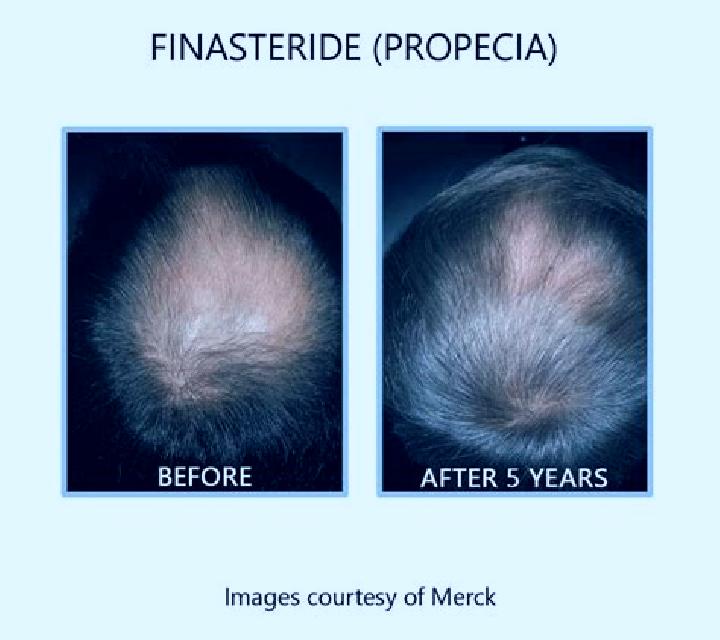 Propecia propecia for diffuse thinning medication