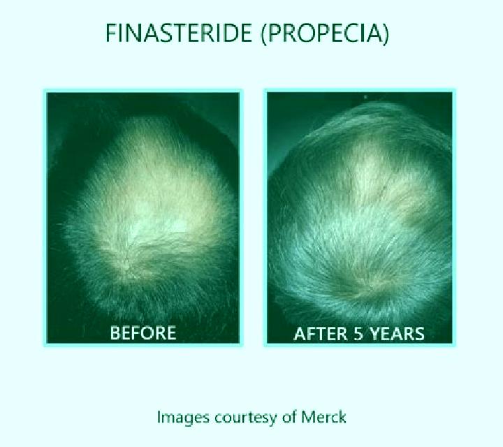 Propecia propecia for diffuse thinning tablet