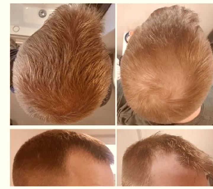 Propecia propecia progress reddit pills