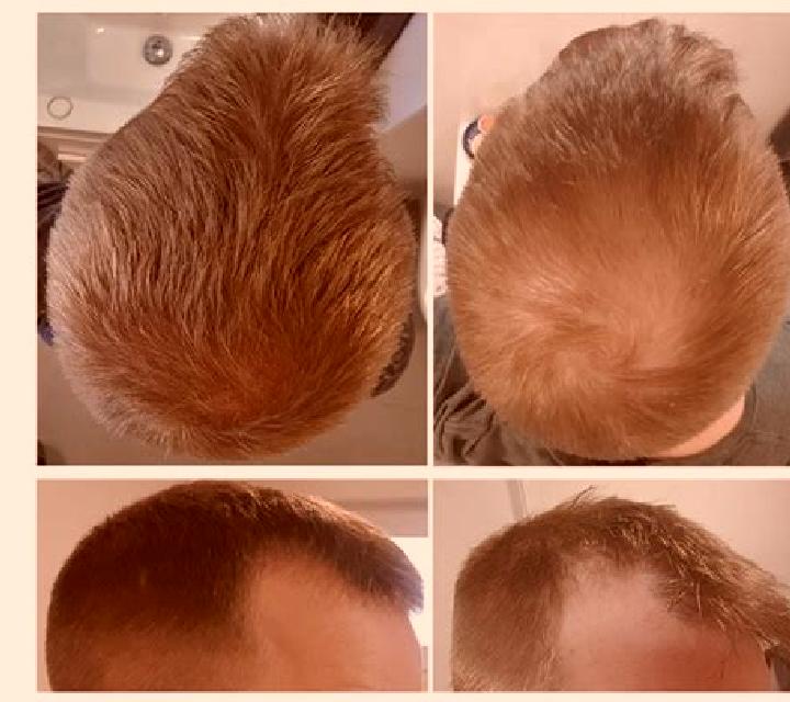 Propecia propecia regrowth progress medication