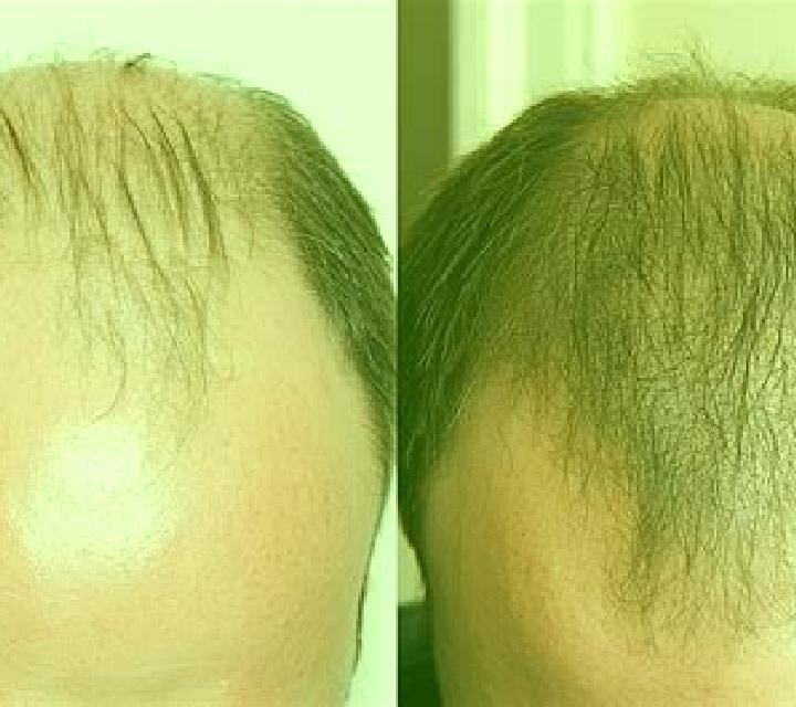Propecia reverse balding without propecia pills