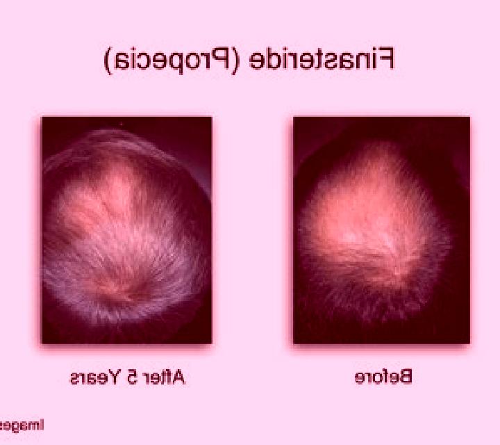 Propecia started propecia shedding normal as before pharmacy