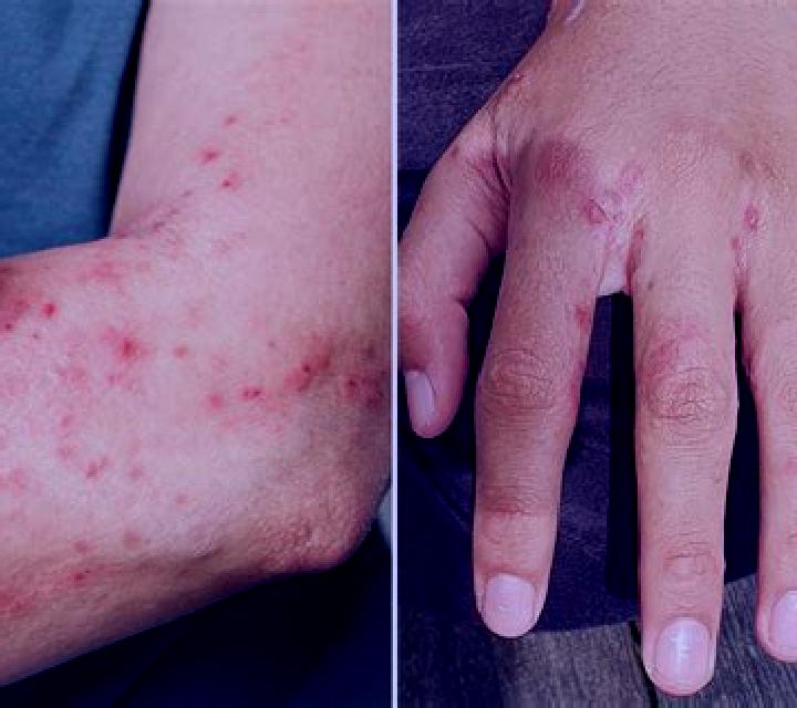 Stromectol stromectol scabies how does it work medication